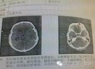 深圳男子被罕見“吃腦蟲”侵入 十幾天后病逝