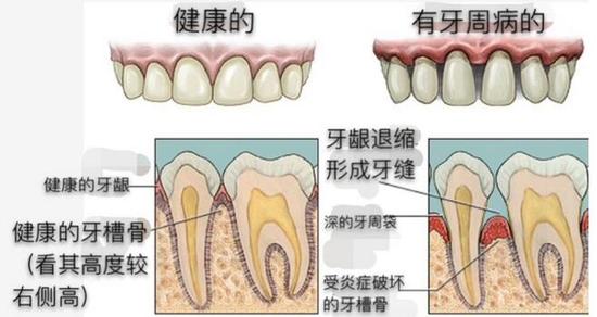 慎用牙簽？牙縫真的越剔越大嗎