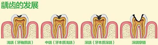 慎用牙簽？牙縫真的越剔越大嗎